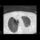 Nasogastric tube in pleural cavity, pneumothorax, pleural effusion: CT - Computed tomography
